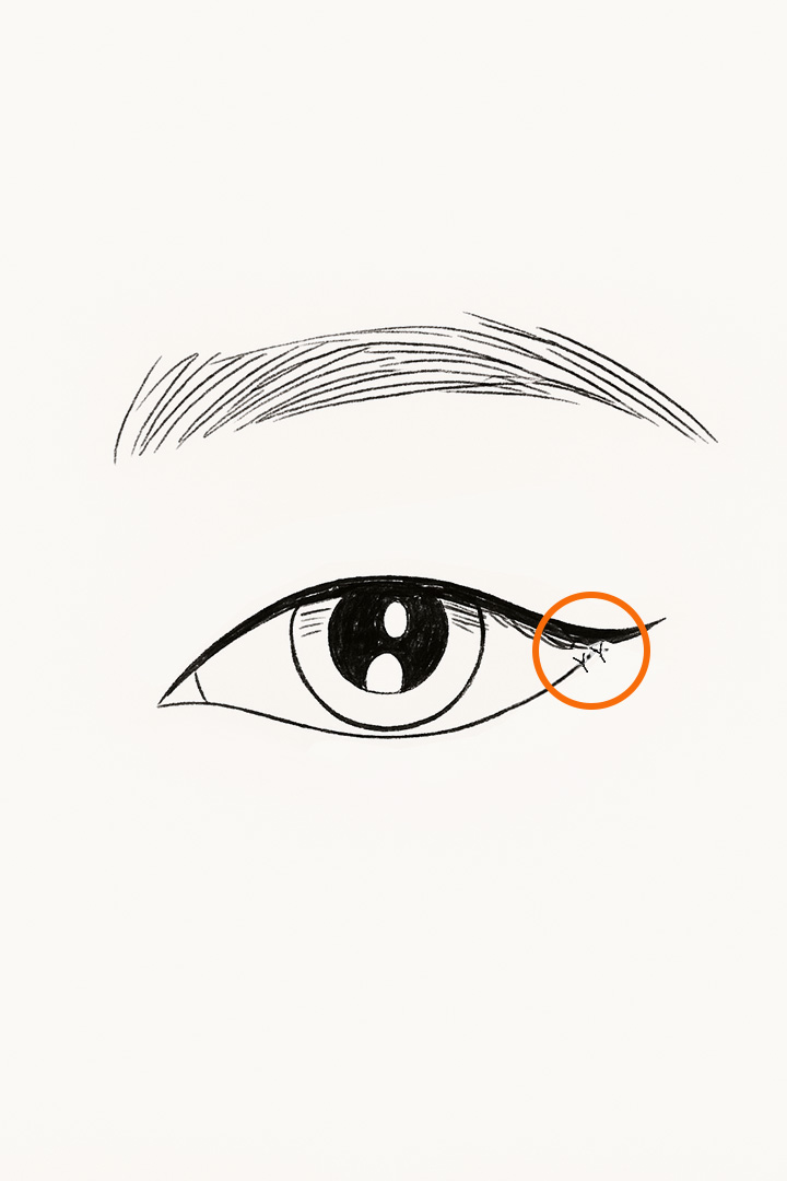 골막 고정 후 봉합합니다.