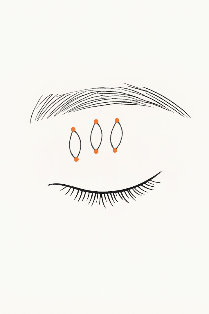 실을 이용하여[b] Muller 근을 당겨줍니다.