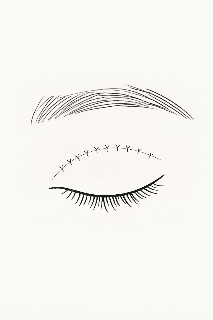 안검판과 안검거근의 끝단에[b] 안륜근을 고정합니다.