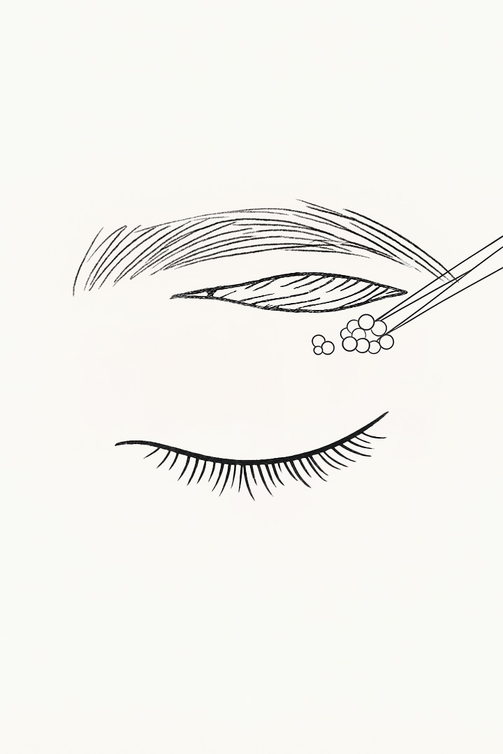 절개 후 늘어진 피부와[b] 지방, 근육을 제거합니다.