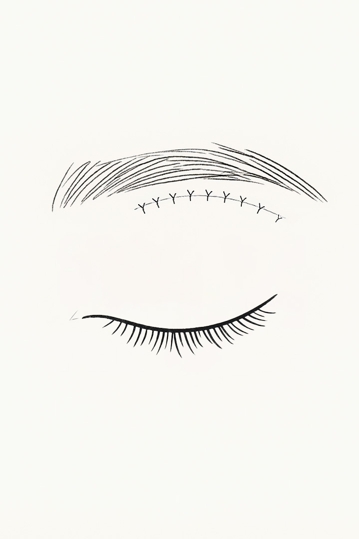 처짐 방지를 위해 골막에[b] 피부를 당겨서 봉합해줍니다.