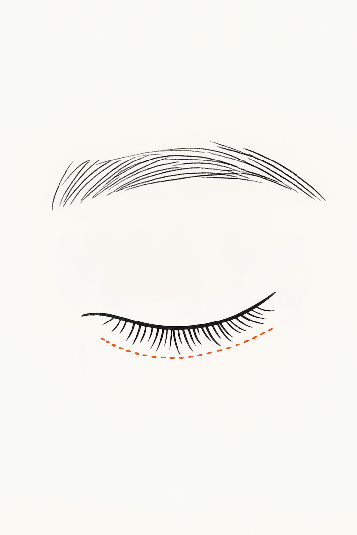 눈 하단으로 쳐진 피부를[m] 따라[d] 절개를 진행합니다.