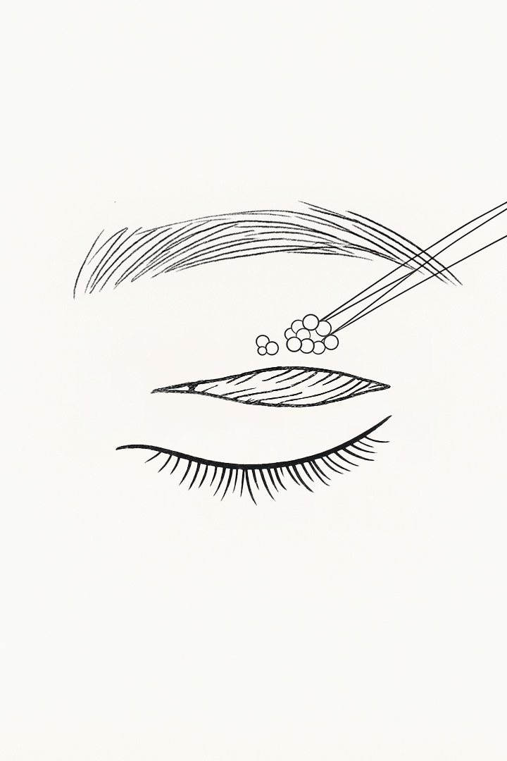 불필요한 피부와 지방을[b] 선택적으로 제거합니다.