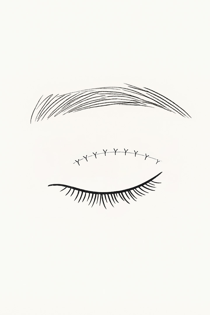 안검판과 안검거근의 끝단에[b] 안륜근을 고정합니다.